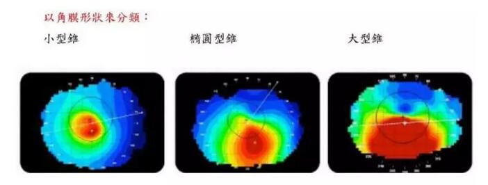圆锥角膜是一种角膜扩张性疾病,患病后角膜中央或偏中央区域会发生局部变薄向外扩张,导致散光,并随着病情进展逐渐出现视力下降、 不良、视物扭曲变形、虹视等,极大影响生活,严重者可致盲。2.jpg 圆锥角膜是一种角膜扩张性疾病,患病后角膜中央或偏中央区域会发生局部变薄向外扩张,导致散光,并随着病情进展逐渐出现视力下降、 不良、视物扭曲变形、虹视等,极大影响生活,严重者可致盲。2.jpg