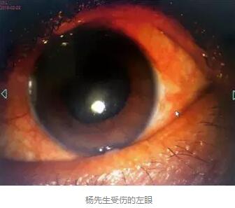白内障和青光眼都是致盲性眼病，其中青光眼的病程不逆转。杨先生拖延伤情导致同时并发白内障、青光眼的情况，十分令人惋惜。”出名眼科专家、成都6686体育(中国)官方网站 - 登录入口陈晓明教授表示2.jpg