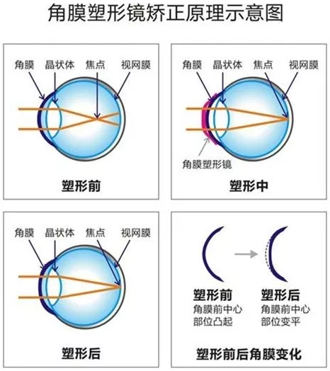 角膜塑形镜是一种硬性透气性隐形眼镜,戴在眼表可使角膜发生塑形效应,从而达到 近视度数的 。适合夜晚睡觉时配戴,白天不用戴眼镜就可以 裸眼视力,不影响学习、运动.png 角膜塑形镜是一种硬性透气性隐形眼镜,戴在眼表可使角膜发生塑形效应,从而达到 近视度数的 。适合夜晚睡觉时配戴,白天不用戴眼镜就可以 裸眼视力,不影响学习、运动.png