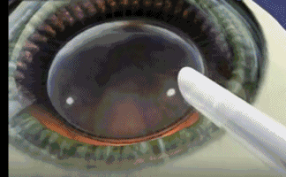 想要当兵视力不达标怎么办？6686体育有这些摘镜术式帮助你3.gif