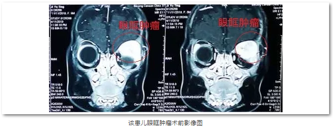 6686体育(中国)官方网站 - 登录入口斜视与小儿眼科主任苏金萍顺利为新生儿摘除眼眶巨大肿瘤1.png