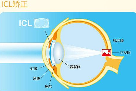 近视无法根治？但你可以这样做？6686体育“有爱就有希望”近视手术火热进行中8.png